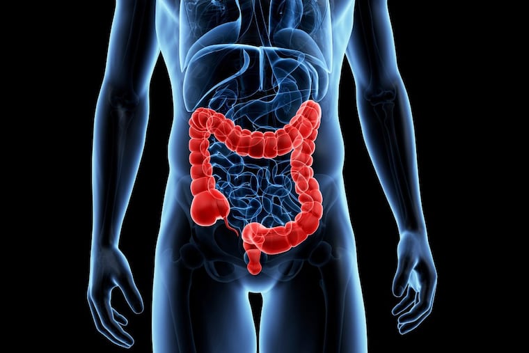The human colon. Colorectal cancer occurs in the colon or rectum when abnormal growths, called polyps, form and become cancerous over time.